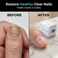 ✨💅 Tratamento para fungos nas unhas com luz azul – cuidado indolor em casa